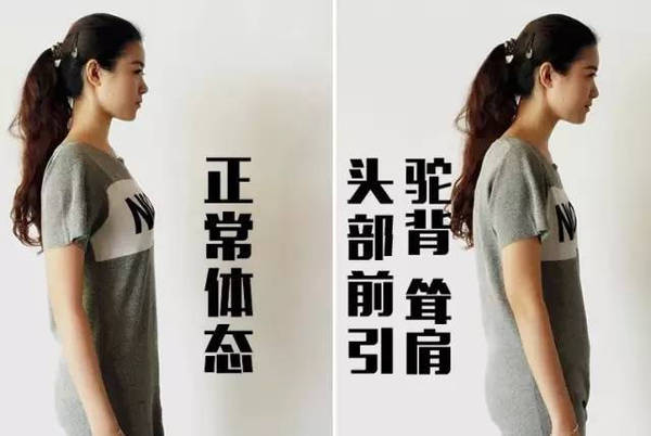 别让孩子在形象上败给了圆肩驼背